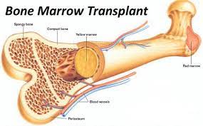 Bone Marrow Transplantation